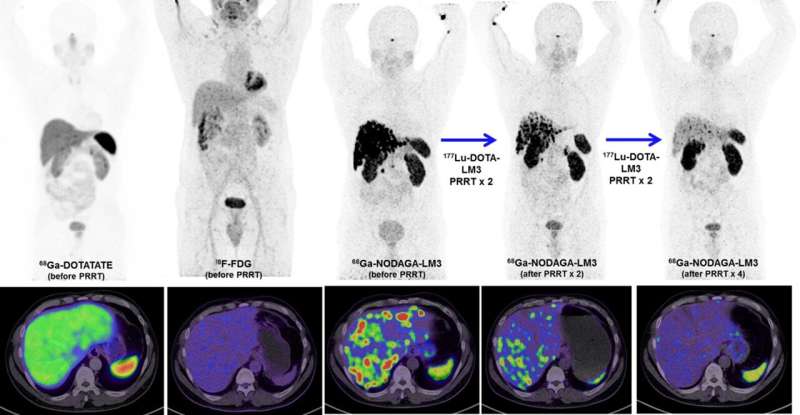 Novel radionuclide therapy proven safe and effective to treat neuroendocrine neoplasms