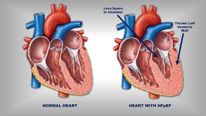 Obesity weakens heart muscle in patients with a common type of heart failure