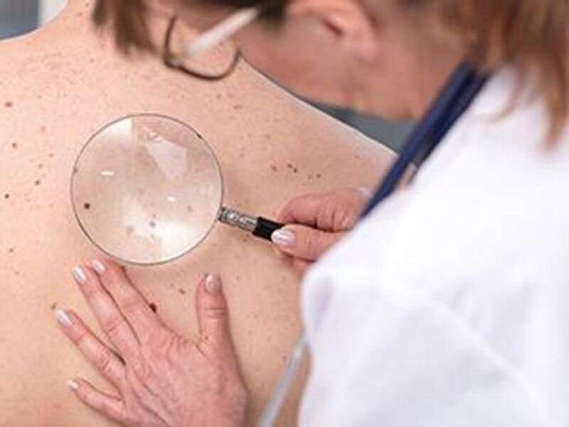 One key question can help spot skin cancer