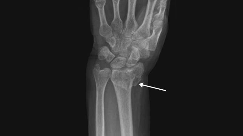 Personalized medicine, not X-rays, should guide forearm fracture treatment in older adults