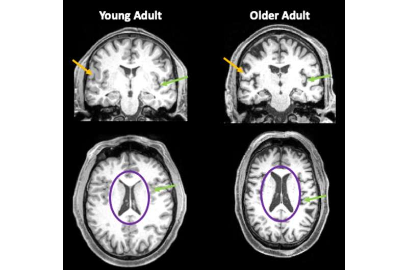 Preliminary research finds that even mild cases of COVID-19 leave a mark on the brain