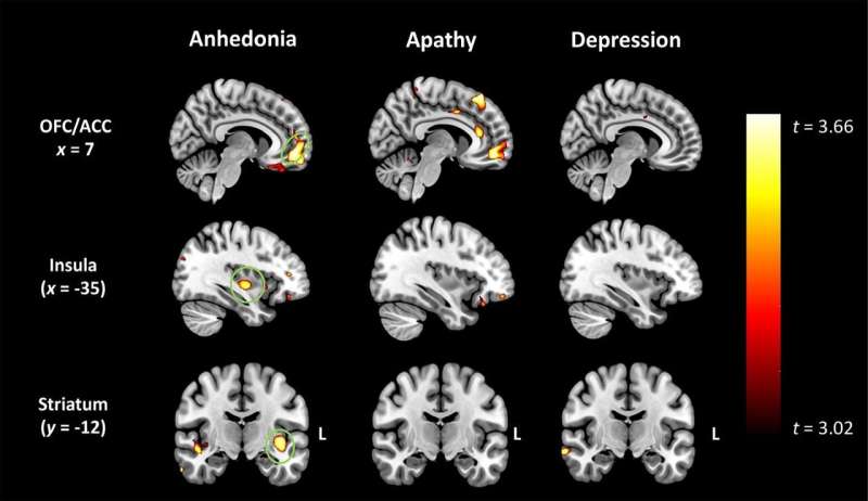 Profound loss of pleasure related to early-onset dementia