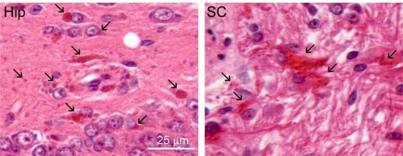 Promising treatment for Alexander disease moves from rat model to human clinical trials