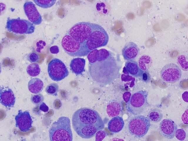 Promising role for whole genome sequencing in guiding blood cancer treatment thumbnail