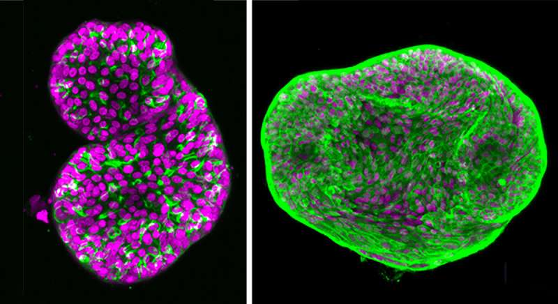 Prostate cancer organoids open path to precision oncology