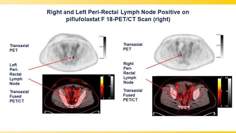 PSMA-targeted radiotracer pinpoints metastatic prostate cancer across anatomic regions