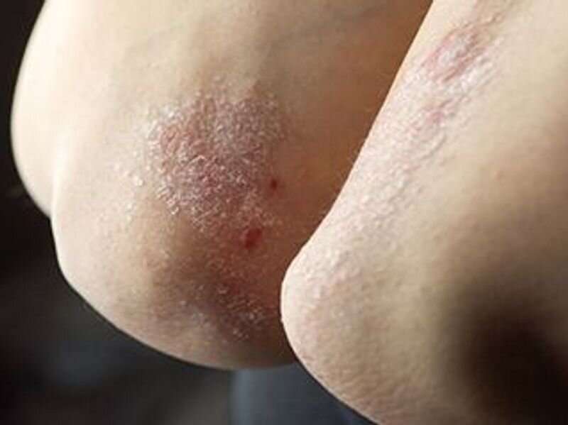 Psoriasis linked to higher risk for thyroid disease