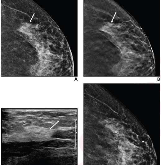 Recalled noncalcified lesions: ultrasound vs. ultrasound plus mammography