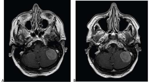 Reduced-dose gadobutrol vs standard-dose gadoterate for contrast-enhanced brain MRI