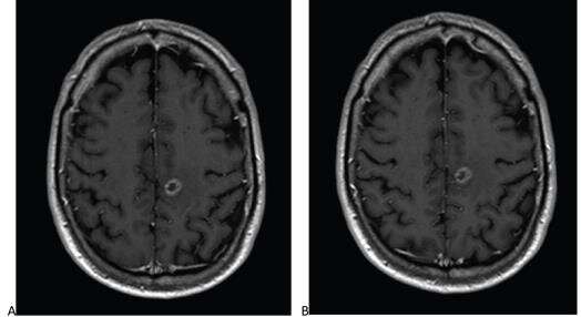 Reduced-dose gadobutrol vs standard-dose gadoterate for contrast-enhanced brain MRI