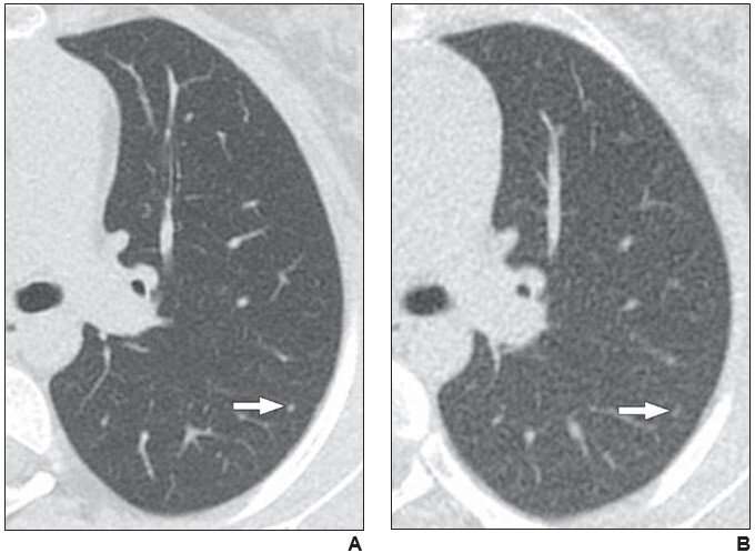 Reduced vs. standard CT dose for lung nodules in children, young adults with cancer