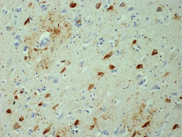 Research sheds light on how Alzheimer's progresses in the brain