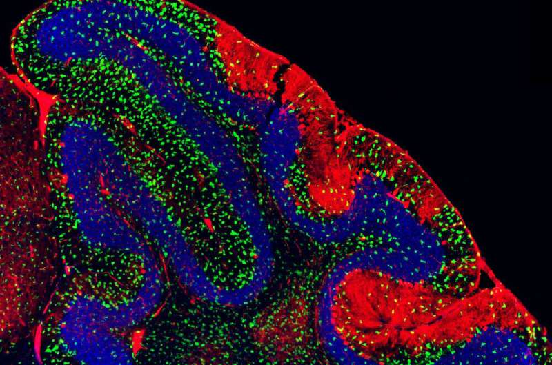 Researchers find immune component to rare neurodegenerative disease