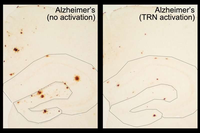 Restoring normal sleep reduces amyloid-beta accumulation in mouse model of Alzheimer's disease