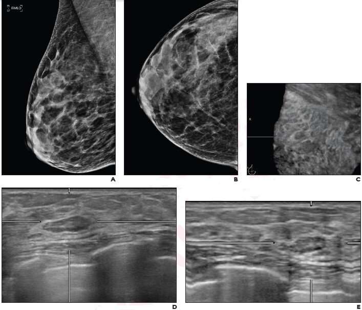 Routine screening for BI-RADS lesions on automated whole-breast ultrasound