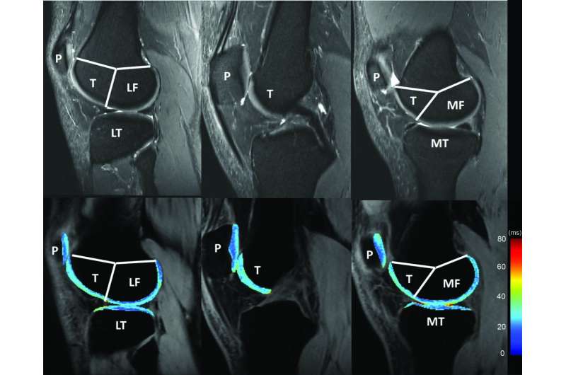 RSNA publishes new QIBA profile for knee cartilage MRI