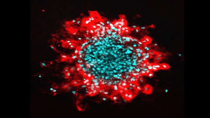 Ruptures in cell nuclei promotes tumor invasion in breast cancer