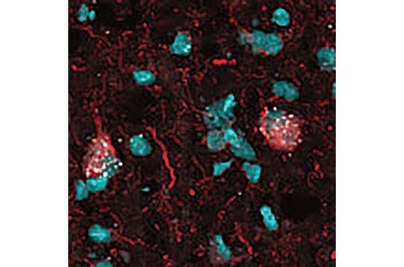 Scientists identify malfunctioning brain cells as potential target for Alzheimer's treatment