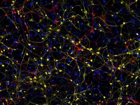科学家揭示了阿尔茨海默氏症患者的脑细胞如何出错，失去他们的身份