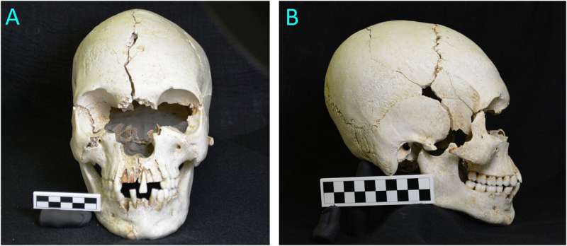 Skull found on Caribbean island shows evidence of leprosy