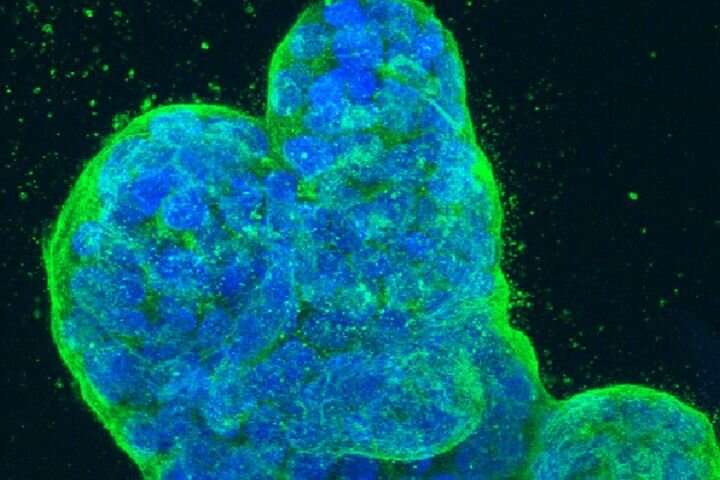 Spread of breast cancer linked to newly discovered RNA splicing mechanism