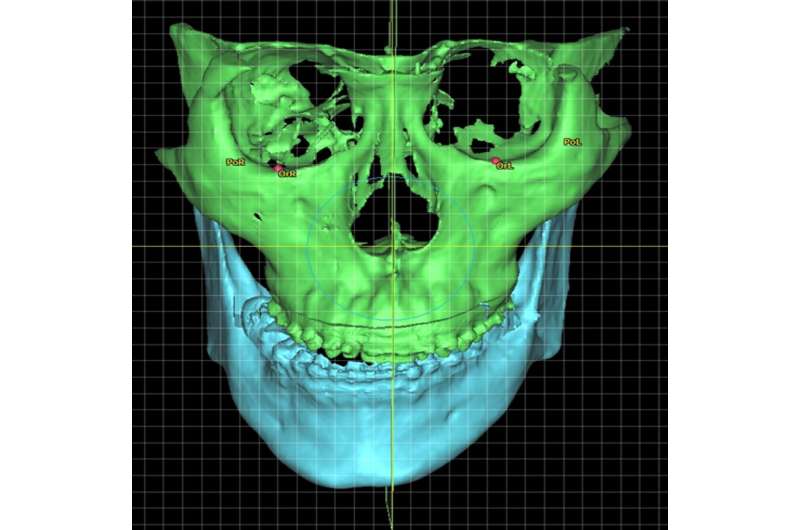 Study finds facial asymmetry correction surgery effective in relieving syndrome of jaw joint pain patients