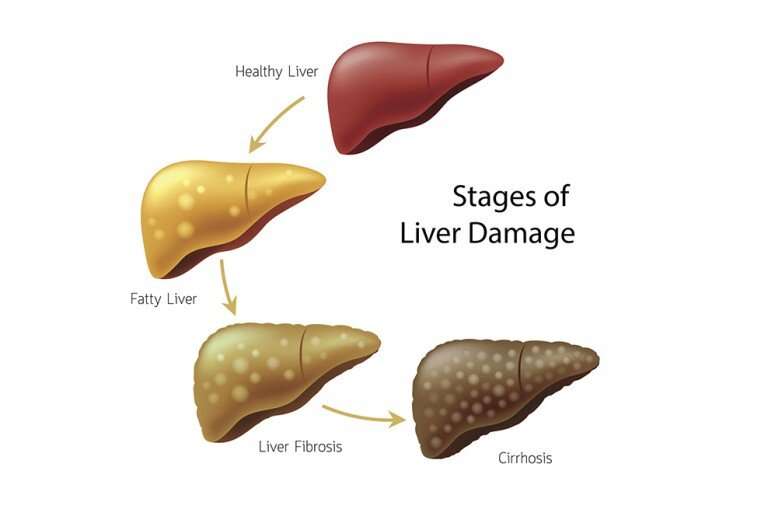 Study finds link between blood sugar and liver disease progression