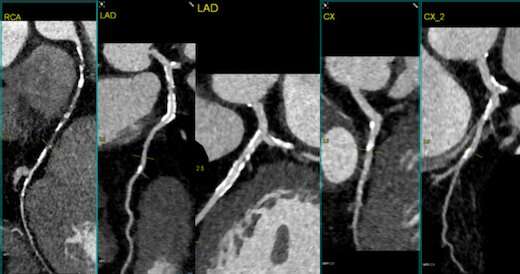 Study of cardiac imaging tests new CT-based procedure