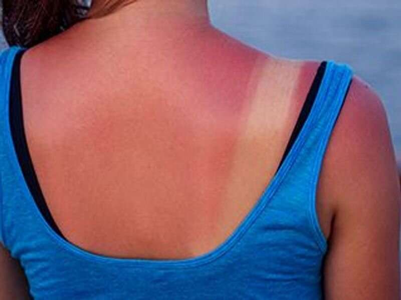Sunburns severe enough to warrant admission described