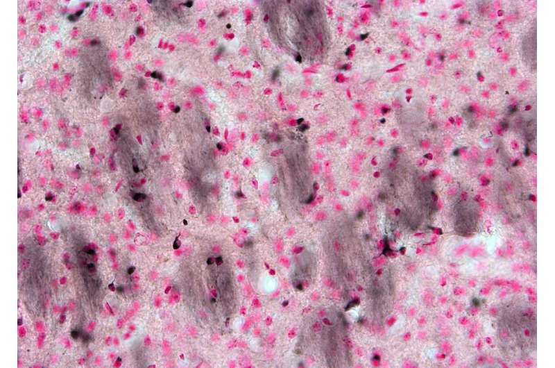 Targeting brain iron in multiple system atrophy offers therapeutic potential