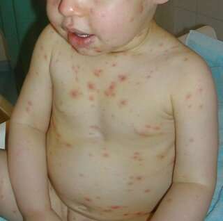 The chickenpox virus has a fascinating evolutionary history that continues to affect peoples' health today