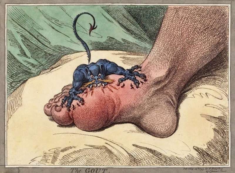 'The disease of kings?' One in 20 Australians get gout — here's how to manage it