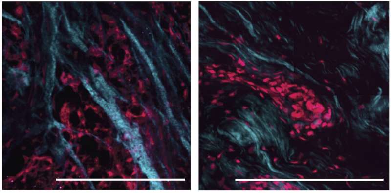 Therapeutic resistance linked to softer tissue environment in breast cancer