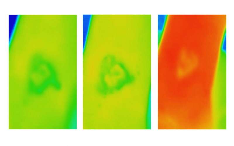 Thermal imaging offers early alert for chronic wound care