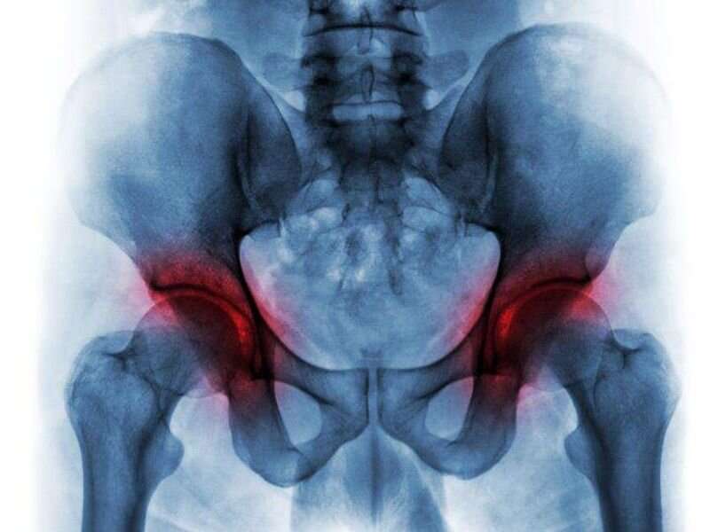 Total hip replacement may influence pelvic stress fracture