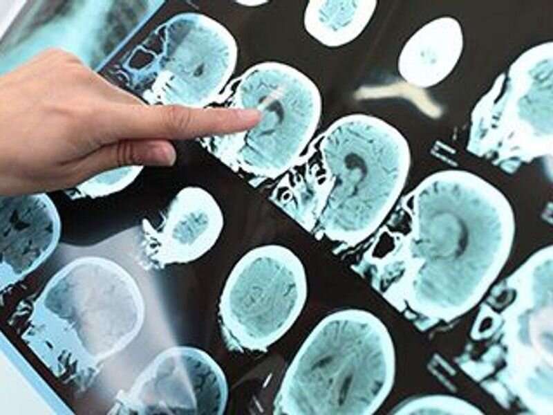Tracking key protein helps predict outcomes in TBI patients