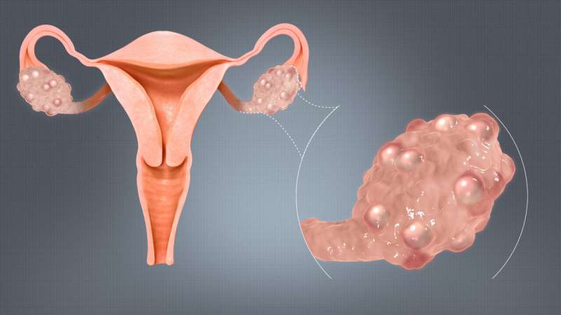 Treating polycystic ovary syndrome costs $8 billion a year in US alone