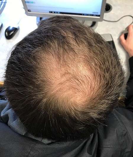 Treating the 'root' cause of baldness with a dissolvable microneedle patch