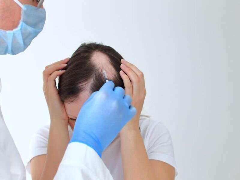 Treatments explored for moderate-to-severe alopecia areata