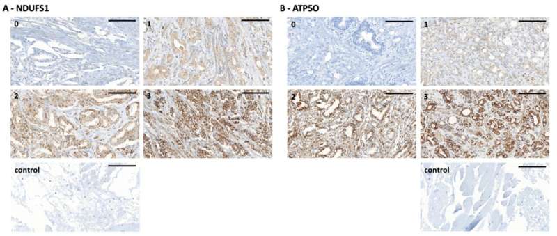 Two proteins identified as novel markers of greater prostate cancer aggressiveness