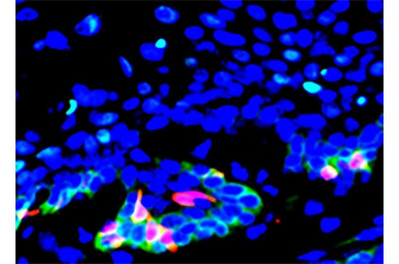 UCLA team discovers how to restrict growth, spread of head and neck cancers