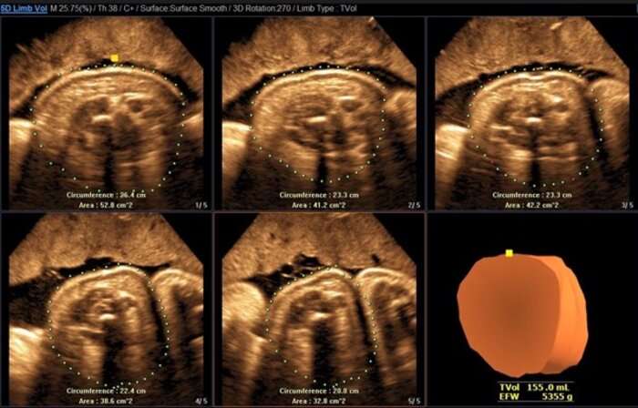 Ultrasonic method improves accuracy of fetal weight prediction during pregnancy