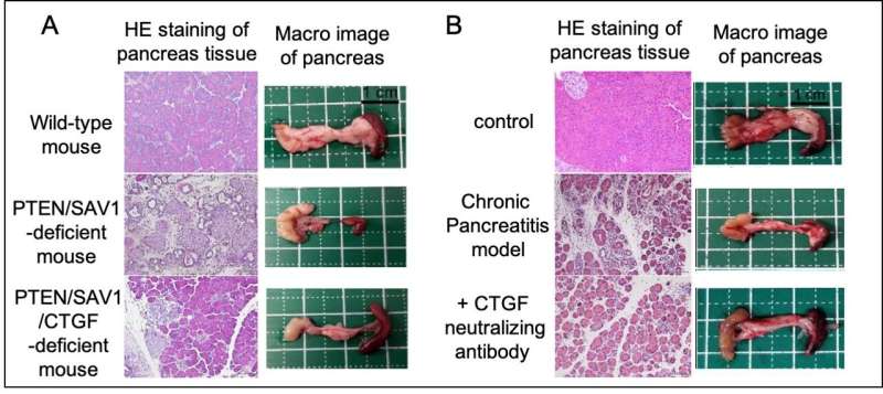 Unforeseen links to chronic pancreatitis found in cancer-related signals