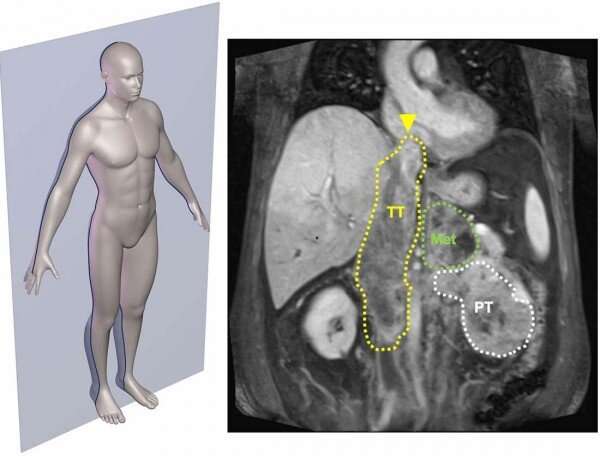 Unusual kidney cancer feature sheds light into how cancers invade and metastasize
