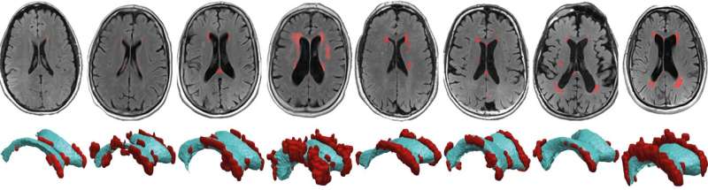 Wear and tear in vulnerable brain areas lead to lesions linked to cognitive decline