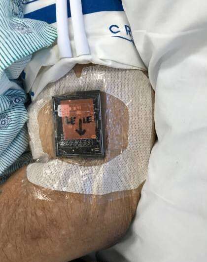 Wearable motion sensors help predict outcomes for patients with severe brain injury