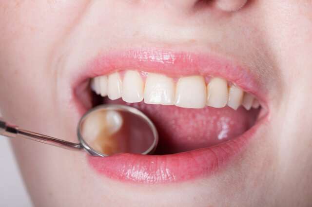 What is gum recession and how do gum grafts work to remedy it?