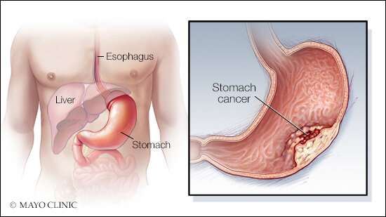 有什么新鲜事在胃癌治疗和研究