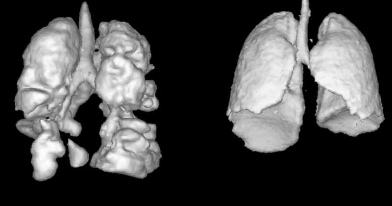 Xenon-aided MRIs snap sharper images of lungs