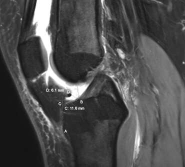 2D and 3D MRIs provide reliable measurements for planning ACL surgery, study shows 